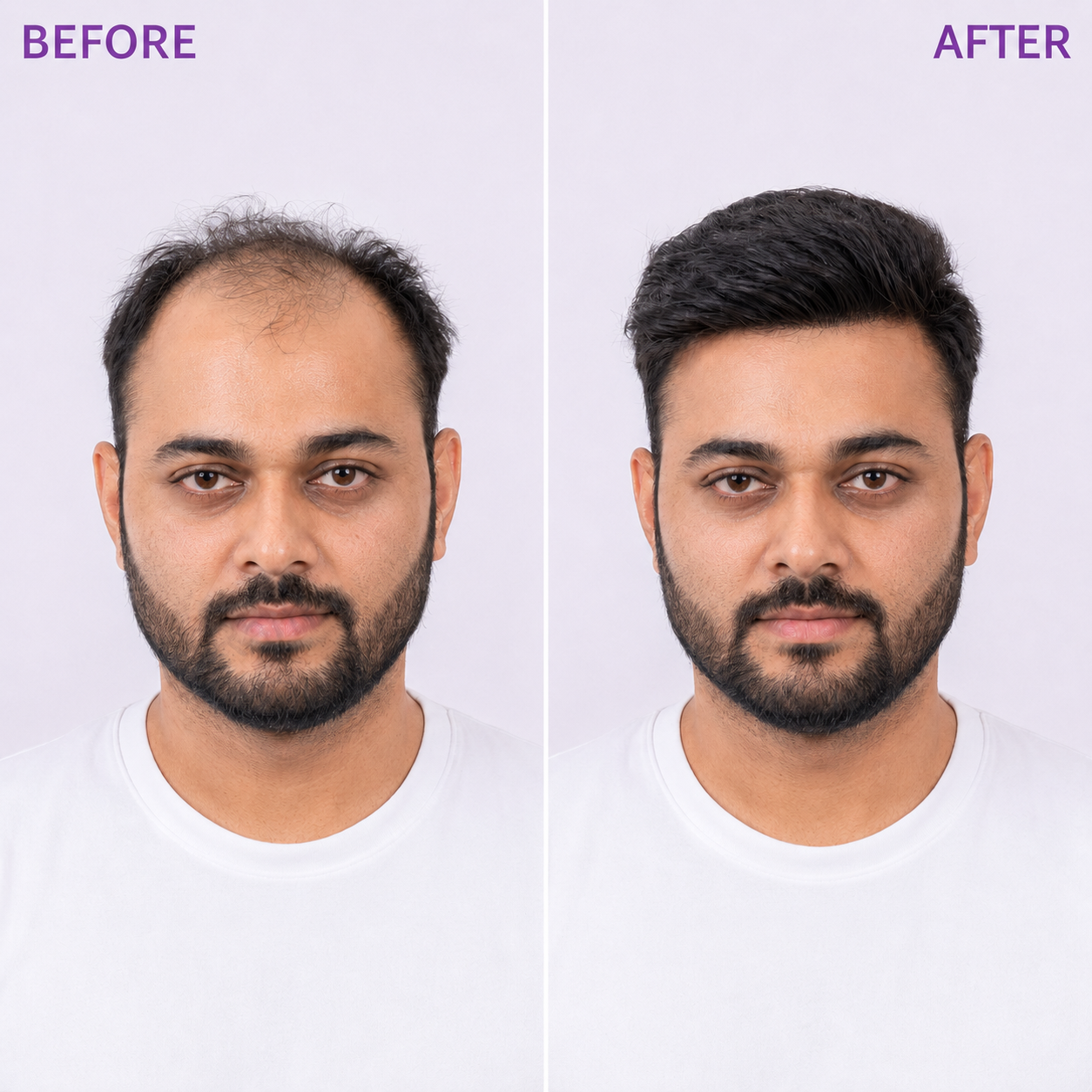 Men's Hair Patch - 100% Real Human Hair The Ramaya Hair